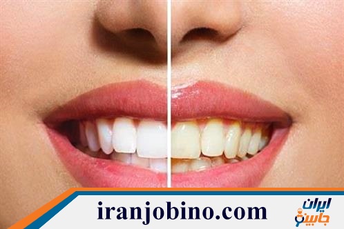 متخصص بلیچینگ دندان در کارون تهران