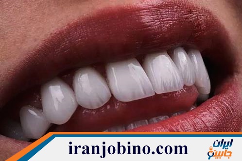 متخصص لمینت دندان در صد دستگاه تهران